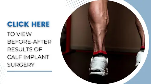 view-before-after-results-of-calf-implant-surgery