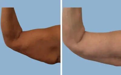 Arm lift before and after result 1 - brachioplasty performed in India, IndiCure patient