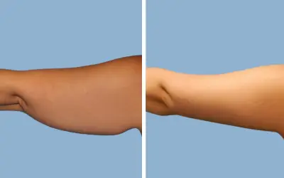 Arm lift before and after result 10 - brachioplasty performed in India, IndiCure patient