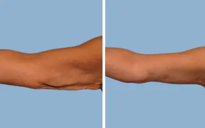 Arm lift before and after result 11 - brachioplasty performed in India, IndiCure patient