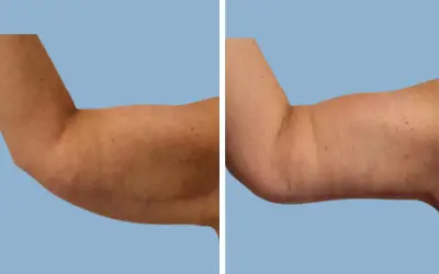 Arm lift before and after result 2 - brachioplasty performed in India, IndiCure patient