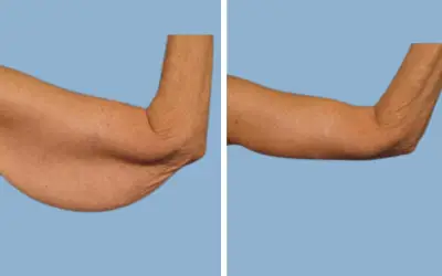 Arm lift before and after result 3 - brachioplasty performed in India, IndiCure patient