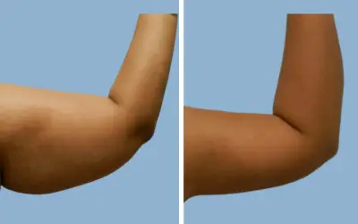 Arm lift before and after result 4 - brachioplasty performed in India, IndiCure patient