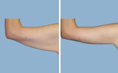 Arm lift before and after result 5 - brachioplasty performed in India, IndiCure patient