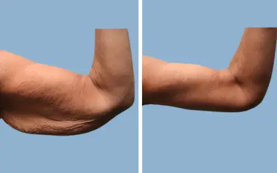 Arm lift before and after result 6 - brachioplasty performed in India, IndiCure patient