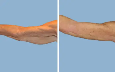 Arm lift before and after result 7 - brachioplasty performed in India, IndiCure patient