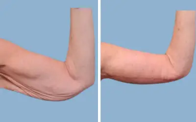 Arm lift before and after result 8 - brachioplasty performed in India, IndiCure patient