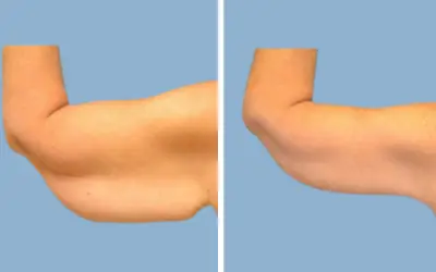 Arm lift before and after result 9 - brachioplasty performed in India, IndiCure patient