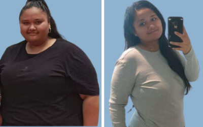 Bariatric surgery before and after result 4 - weight loss surgery in India, IndiCure patient