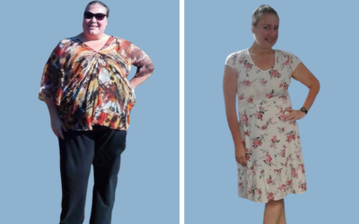 Bariatric surgery before and after result 5 - weight loss surgery in India, IndiCure patient
