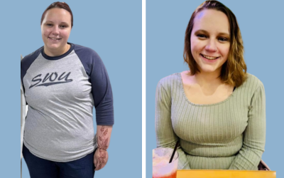 Bariatric surgery before and after result 6 - weight loss surgery in India, IndiCure patient