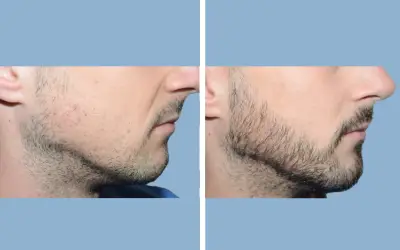 Beard transplant before and after result 1 - performed in India, IndiCure patient