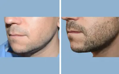 Beard transplant before and after result 2 - performed in India, IndiCure patient