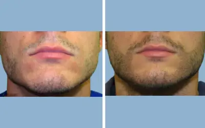 Beard transplant before and after result 3 - performed in India, IndiCure patient