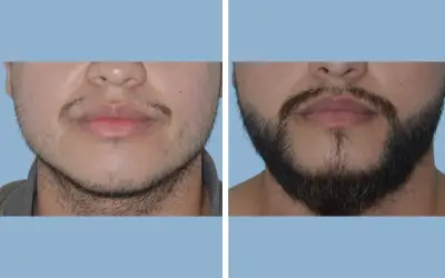 Beard transplant before and after result 4 - performed in India, IndiCure patient