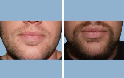 Beard transplant before and after result 5 - performed in India, IndiCure patient