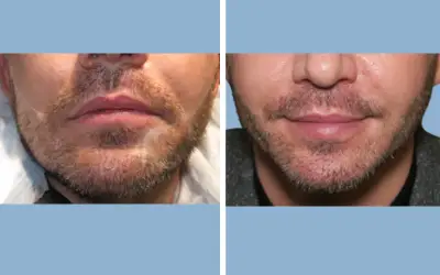 Beard transplant before and after result 6 - performed in India, IndiCure patient
