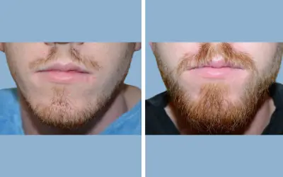 Beard transplant before and after result 7 - performed in India, IndiCure patient