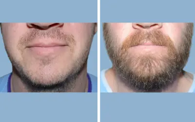 Beard transplant before and after result 8 - performed in India, IndiCure patient
