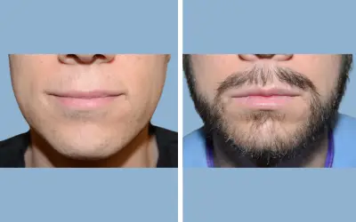 Beard transplant before and after result 9 - performed in India, IndiCure patient