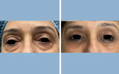 Blepharoplasty before and after result 1 - eyelid surgery in India, IndiCure patient