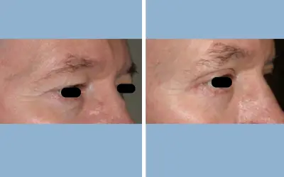 Blepharoplasty before and after result 10 - eyelid surgery in India, IndiCure patient