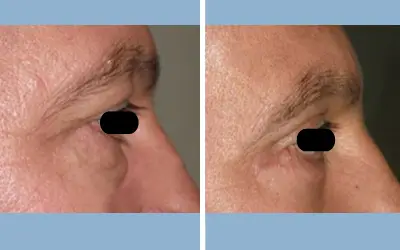 Blepharoplasty before and after result 11 - eyelid surgery in India, IndiCure patient