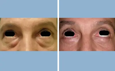 Blepharoplasty before and after result 2 - eyelid surgery in India, IndiCure patient