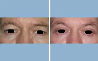 Blepharoplasty before and after result 3 - eyelid surgery in India, IndiCure patient