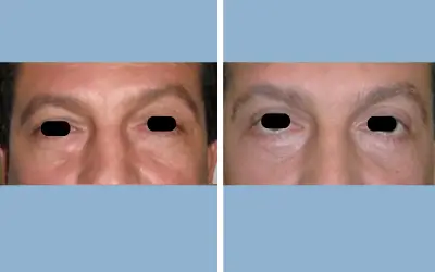 Blepharoplasty before and after result 4 - eyelid surgery in India, IndiCure patient