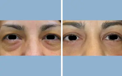 Blepharoplasty before and after result 5 - eyelid surgery in India, IndiCure patient