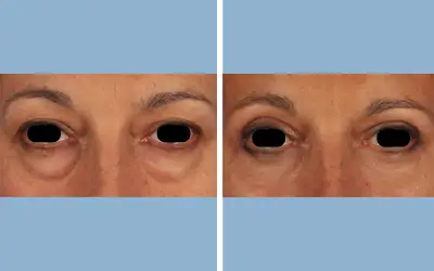 Blepharoplasty before and after result 6 - eyelid surgery in India, IndiCure patient