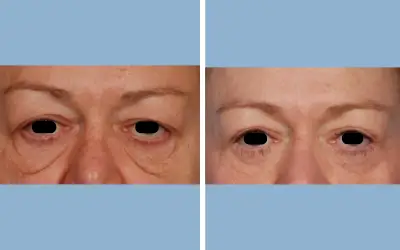 Blepharoplasty before and after result 7 - eyelid surgery in India, IndiCure patient