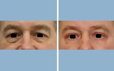 Blepharoplasty before and after result 8 - eyelid surgery in India, IndiCure patient