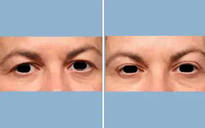 Blepharoplasty before and after result 9 - eyelid surgery in India, IndiCure patient