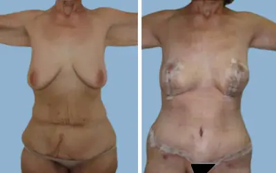 Body lift before and after result 1 - total body lift surgery in India, IndiCure patient