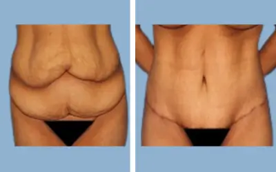 Body lift before and after result 10 - total body lift surgery in India, IndiCure patient