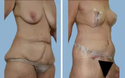 Body lift before and after result 2 - total body lift surgery in India, IndiCure patient