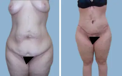 Body lift before and after result 3 - total body lift surgery in India, IndiCure patient