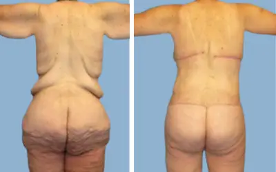 Body lift before and after result 4 - total body lift surgery in India, IndiCure patient