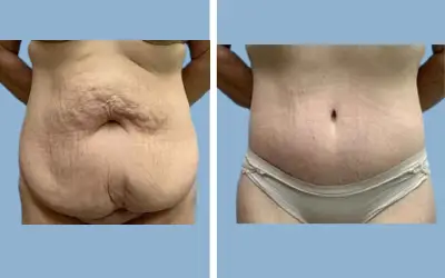 Body lift before and after result 5 - total body lift surgery in India, IndiCure patient
