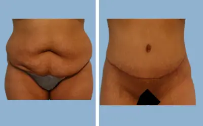Body lift before and after result 6 - total body lift surgery in India, IndiCure patient