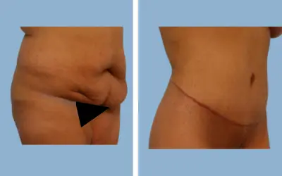 Body lift before and after result 7 - total body lift surgery in India, IndiCure patient