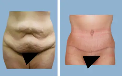 Body lift before and after result 8 - total body lift surgery in India, IndiCure patient