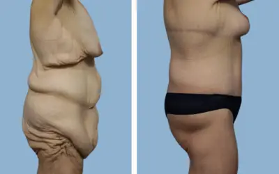 Body lift before and after result 9 - total body lift surgery in India, IndiCure patient