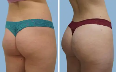 Brazilian butt lift before and after result 1 - BBL performed in India, IndiCure patient