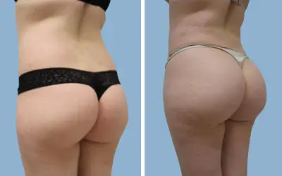 Brazilian butt lift before and after result 10 - BBL performed in India, IndiCure patient