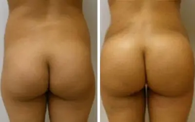 Brazilian butt lift before and after result 12 - BBL performed in India, IndiCure patient