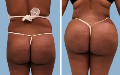 Brazilian butt lift before and after result 13 - BBL performed in India, IndiCure patient