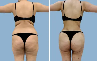Brazilian butt lift before and after result 14 - BBL performed in India, IndiCure patient